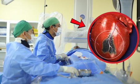 Người đàn ông 57 tuổi bất ngờ lên cơn nhồi máu cơ tim sau bữa tối