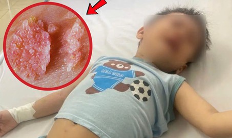 Bé trai 3 tuổi bị sùi mào gà trên mặt, 'thủ phạm' là thứ rất quen thuộc