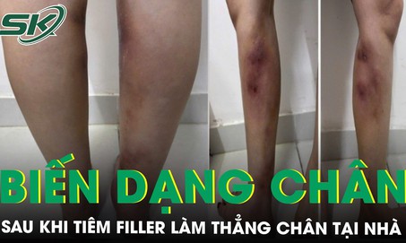 Cô gái 29 tuổi biến dạng hai cẳng chân sau khi tiêm filler làm thẳng chân tại nhà