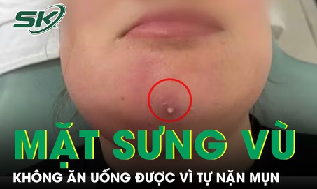 Nặn mụn cằm, người phụ nữ nhập viện vì mặt sưng vù, không ăn uống được 