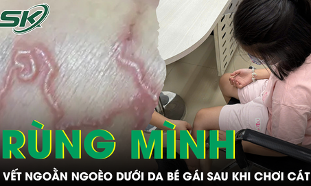 Tá hỏa phát hiện bắp chân bé gái 9 tuổi đầy vết ngoằn ngoèo bất thường