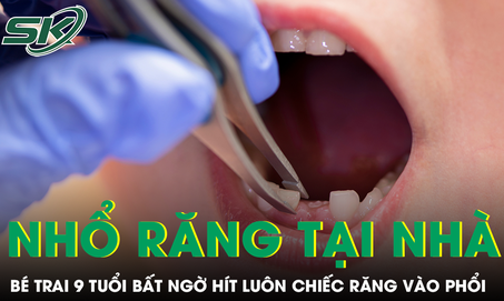 Được mẹ nhổ răng tại nhà, bé trai 9 tuổi bất ngờ hít luôn chiếc răng vào phổi