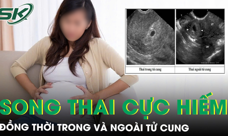 Sản phụ mang song thai cực hiếm, đồng thời trong và ngoài tử cung 