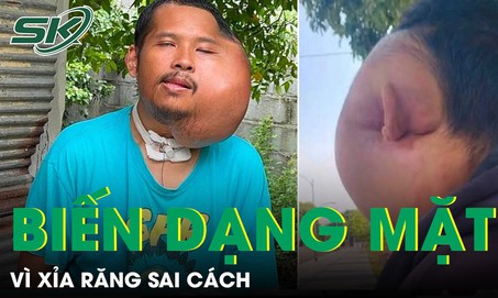 Xỉa răng sai cách, người đàn ông biến dạng khuôn mặt đến khó tin