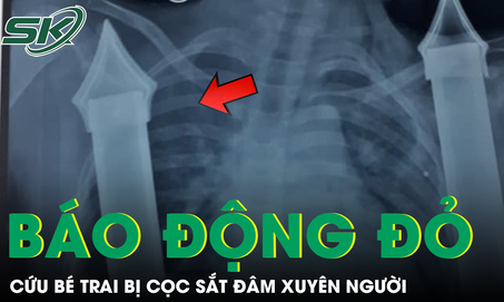 Bé trai 6 tuổi nguy kịch do cọc sắt xuyên từ bụng xuống tầng sinh môn