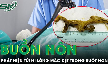 Hay đau bụng, buồn nôn, người đàn ông phát hiện túi ni lông trong ruột non