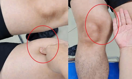 Đùi to bất thường suốt một năm, người đàn ông phát hiện ung thư hiếm gặp