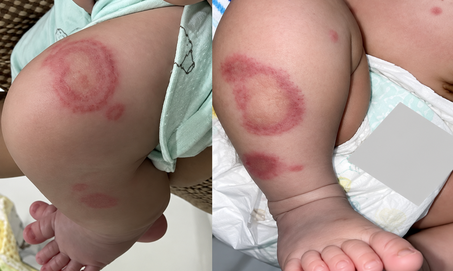 Em bé 26 ngày tuổi mắc lupus sơ sinh, khắp người xuất hiện mảng đỏ bất thường