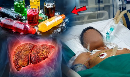 Uống nhiều nước ngọt có làm tăng nguy cơ ung thư gan?