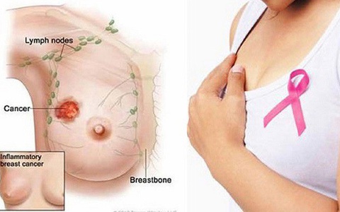 Bệnh Paget vú: Nhận biết, chẩn đoán và điều trị thế nào?