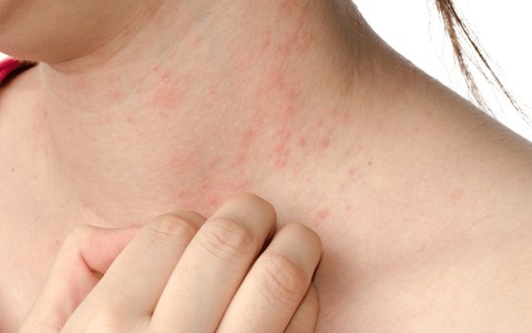 Gan nhiễm mỡ có thể gây ra cảm giác ngứa ngáy khó chịu do độc tố tích tụ dưới da rạng rỡ và bền bỉ 