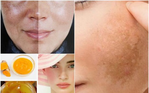 Thực Hư Retinol Trị Nám Sự Thật Và Giải Đáp