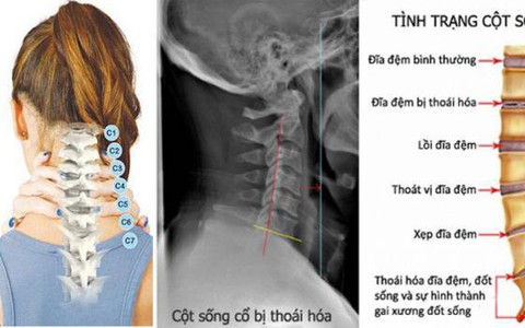 thoái hóa cột sống cổ - Báo Sức khỏe & Đời sống - Cơ quan ngôn ...