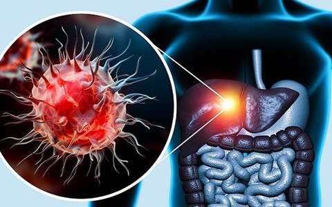 Bỏ điều trị viêm gan B mạn tính, người đàn ông nguy kịch phải ghép gan cấp  cứu