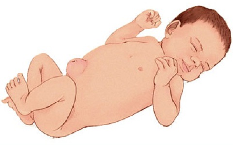 Cách chăm sóc rốn cho trẻ sơ sinh tránh bị nhiễm trùng