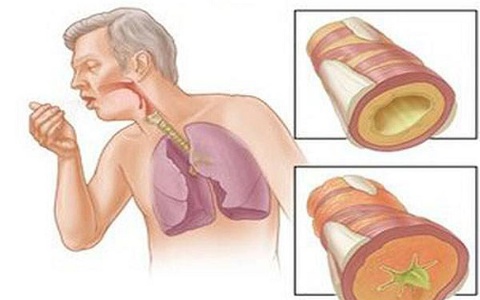 Vừa bị tiểu đường vừa bị lao phổi: Nguyên nhân, triệu chứng và giải pháp điều trị hiệu quả