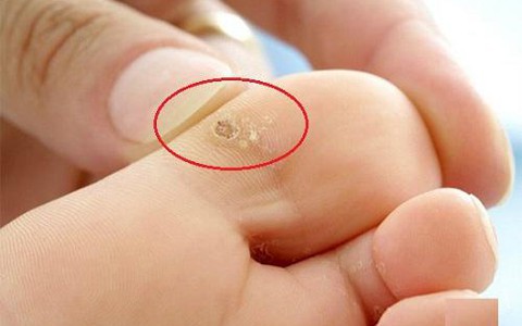 C&oacute; phải l&agrave; mụn c&oacute;c?