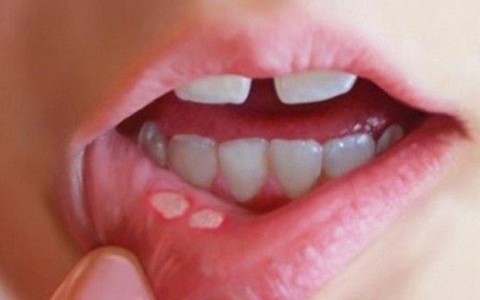 5 nguyên nhân gây loét miệng ở người nhiễm HIV