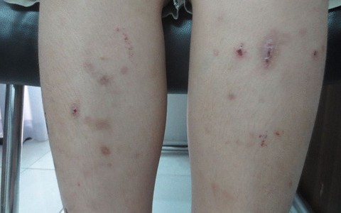 DẤU HIỆU TRẺ EM BỊ NHIỄM GIUN CẦN ĐƯỢC PHÁT HIỆN SỚM