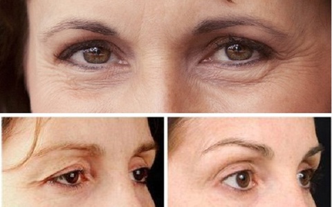 Sụp mi mắt: Nguyên nhân, triệu chứng, điều trị và cách khắc phục