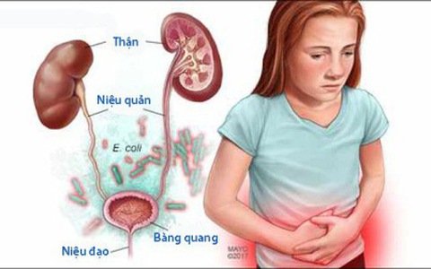 6. Biến chứng của nhiễm trùng ổ bụng