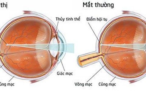 cận thị ở trẻ nhỏ có nguy hiểm - Báo Sức khỏe & Đời sống - Cơ quan ...