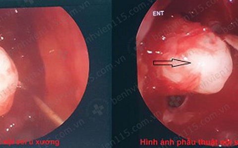 Mô tả và Đặc điểm của U Xương Xoang Sàng