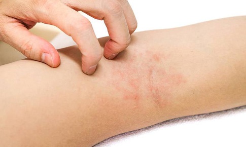 Giải pháp an toàn cho bệnh viêm da cơ địa mùa COVID