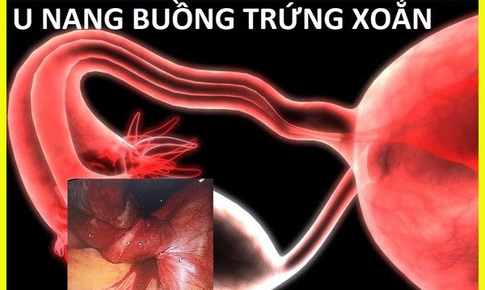 U nang buồng trứng có nguy hiểm không? Làm thế nào để phòng bệnh?