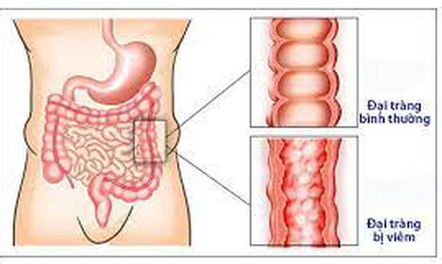 5 bài thuốc nam điều trị viêm đại tràng mạn tính