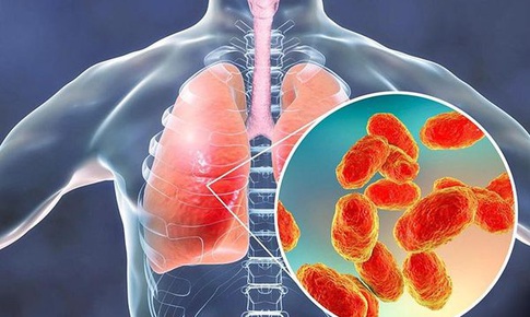 Bệnh viêm tiểu phế quản ở trẻ: Nhận biết, điều trị và những lưu ý
