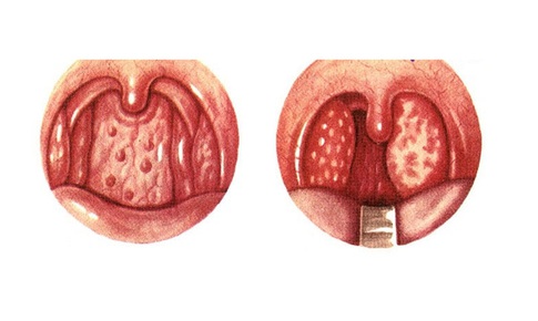 Vi&#234;m họng hạt: Nguy&#234;n nh&#226;n, triệu chứng chẩn đo&#225;n, điều trị v&#224; ph&#242;ng ngừa