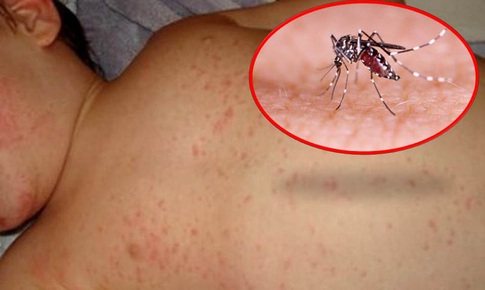 Cảnh gi&#225;c với biến chứng của bệnh sốt xuất huyết Dengue 