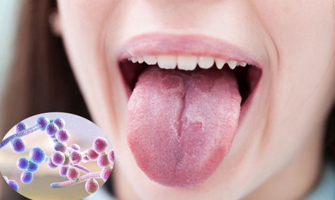 FDA cấp phép thuốc mới điều trị bệnh nấm Candida xâm lấn