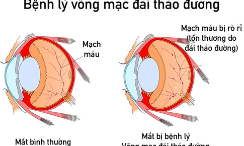 Bệnh v&#245;ng mạc đ&#225;i th&#225;o đường - Những điều cần biết