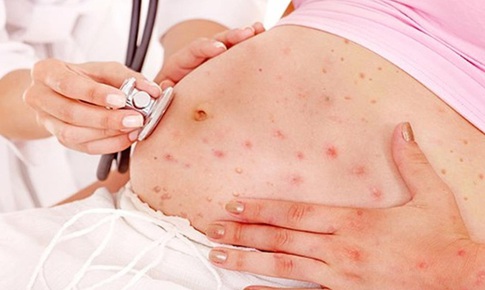 Bệnh thủy đậu khi mang thai, nguy hiểm thế nào?