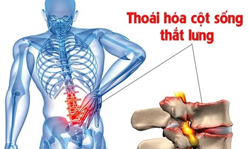 Tho&#225;i h&#243;a cột sống thắt lưng: Nguy&#234;n nh&#226;n, triệu chứng v&#224; c&#225;ch điều trị hiệu quả 