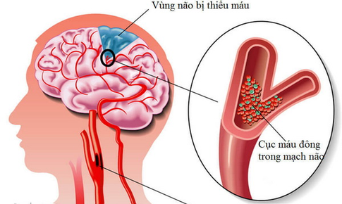 3 dấu hiệu sớm cảnh báo đột quỵ trước cả FAST