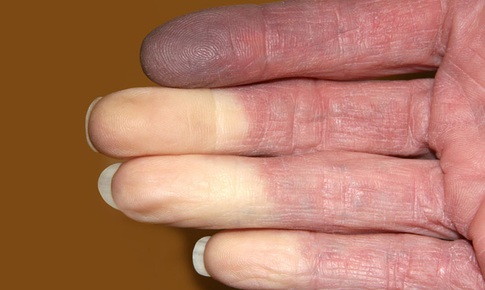 Hội chứng Raynaud l&#224; g&#236;, chữa thế n&#224;o?