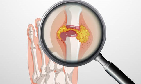 Hỗ trợ kiểm soát gout mạn tính nhờ sản phẩm thảo dược
