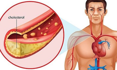 Cholesterol cao đẩy nhanh tốc độ xơ vữa mạch v&#224;nh, thiếu m&#225;u cơ tim