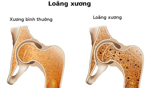 Phụ nữ U50 và những phương pháp phòng ngừa loãng xương, gãy xương