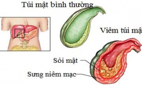 Day ấn huyệt hỗ trợ trị vi&#234;m t&#250;i mật