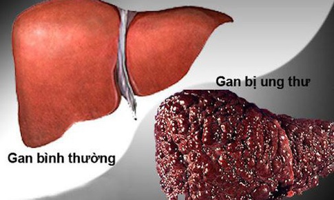 Điểm mặt những nguyên nhân gây ung thư gan