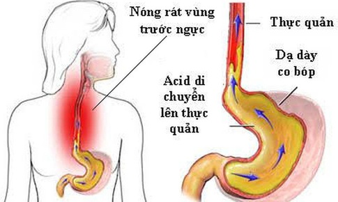 5 b&#224;i thuốc sắc trị tr&#224;o ngược dạ d&#224;y thực quản