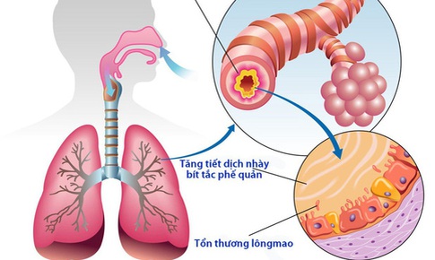 Hai b&#224;i thuốc trị chứng phế ung