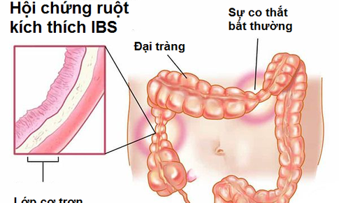 Trị hội chứng ruột k&#237;ch th&#237;ch như thế n&#224;o?