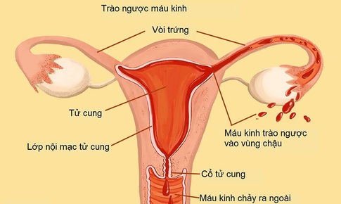 T&#236;m ra gen g&#226;y bệnh, ph&#225;t triển thuốc trị lạc nội mạc tử cung