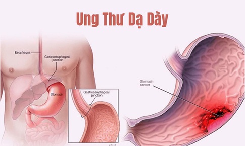 Phòng ung thư dạ dày, những dấu hiệu nguy cơ nên tầm soát sớm