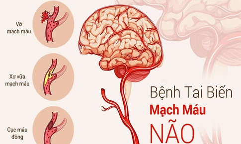 Mắc COVID-19 và nguy cơ đột quỵ não cấp